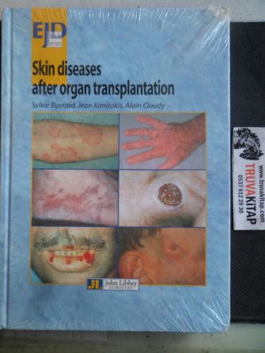 Skin Diseases After Organ Transplantation Sylvie Euvrard